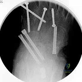 العودة لارتداء الأحذية العادية والمشي