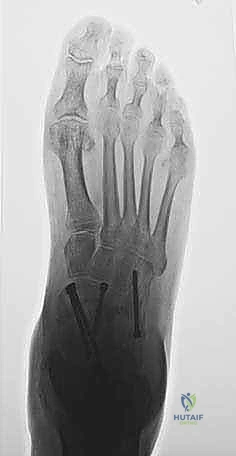 Illustration of traditional triple arthrodesis - Dr. Mohammed Hutaif