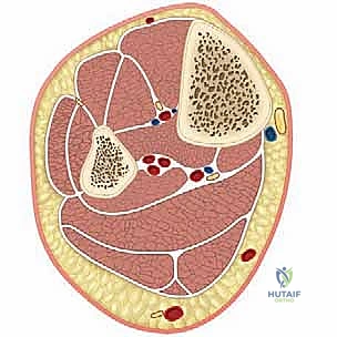 بضع اللفافة لعلاج متلازمة الحيز الجهدي المزمنة: دليل شامل للمرضى مع الأستاذ الدكتور محمد هطيف