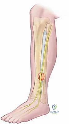 آلية حدوث متلازمة الحيز الجهدي المزمنة في الساق