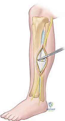 تأثير تضخم العضلات على اللفافة غير المرنة