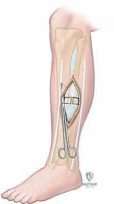 التشريح المقطعي لحيزات الساق الأربعة