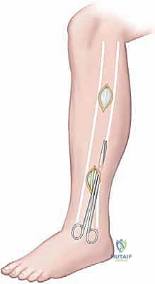 جهاز قياس الضغط داخل الحيز أثناء الفحص