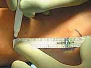 توضيح مسار العصب الشظوي السطحي في الساق