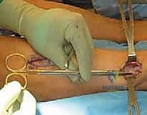 إدخال الإبرة لقياس الضغط في الحيز الأمامي