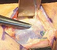 فحص الساق والبحث عن فتق العضلات