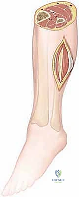صورة رنين مغناطيسي توضح الوذمة العضلية في الساق