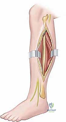بضع اللفافة لعلاج متلازمة الحيز الجهدي المزمنة: دليل شامل للمرضى مع الأستاذ الدكتور محمد هطيف