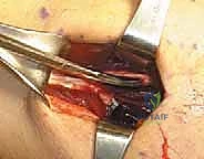 صورة طبية: بضع اللفافة لعلاج متلازمة الحيز الجهدي المزمنة: دليل شامل للمرضى مع الأستاذ الدكتور محمد هطيف