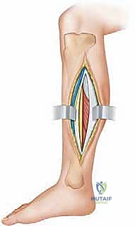 صورة طبية: بضع اللفافة لعلاج متلازمة الحيز الجهدي المزمنة: دليل شامل للمرضى مع الأستاذ الدكتور محمد هطيف