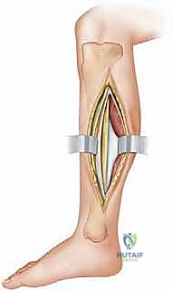 صورة طبية: بضع اللفافة لعلاج متلازمة الحيز الجهدي المزمنة: دليل شامل للمرضى مع الأستاذ الدكتور محمد هطيف