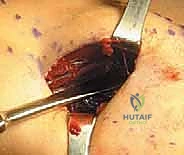 صورة طبية: بضع اللفافة لعلاج متلازمة الحيز الجهدي المزمنة: دليل شامل للمرضى مع الأستاذ الدكتور محمد هطيف