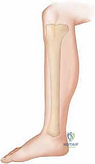 صورة طبية: بضع اللفافة لعلاج متلازمة الحيز الجهدي المزمنة: دليل شامل للمرضى مع الأستاذ الدكتور محمد هطيف