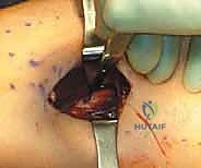 صورة توضيحية لـ بضع اللفافة لعلاج متلازمة الحيز الجهدي المزمنة: دليل شامل للمرضى مع الأستاذ الدكتور محمد هطيف