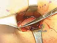 صورة طبية: بضع اللفافة لعلاج متلازمة الحيز الجهدي المزمنة: دليل شامل للمرضى مع الأستاذ الدكتور محمد هطيف