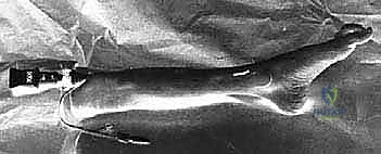 صورة توضيحية لـ بضع اللفافة لعلاج متلازمة الحيز الجهدي المزمنة: دليل شامل للمرضى مع الأستاذ الدكتور محمد هطيف