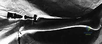 صورة طبية: بضع اللفافة لعلاج متلازمة الحيز الجهدي المزمنة: دليل شامل للمرضى مع الأستاذ الدكتور محمد هطيف