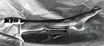 صورة طبية: بضع اللفافة لعلاج متلازمة الحيز الجهدي المزمنة: دليل شامل للمرضى مع الأستاذ الدكتور محمد هطيف