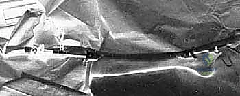 صورة طبية: بضع اللفافة لعلاج متلازمة الحيز الجهدي المزمنة: دليل شامل للمرضى مع الأستاذ الدكتور محمد هطيف