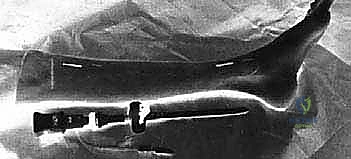 صورة طبية: بضع اللفافة لعلاج متلازمة الحيز الجهدي المزمنة: دليل شامل للمرضى مع الأستاذ الدكتور محمد هطيف