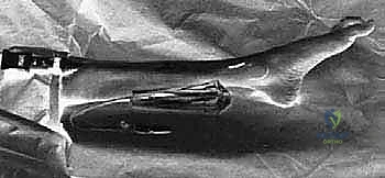 صورة طبية: بضع اللفافة لعلاج متلازمة الحيز الجهدي المزمنة: دليل شامل للمرضى مع الأستاذ الدكتور محمد هطيف