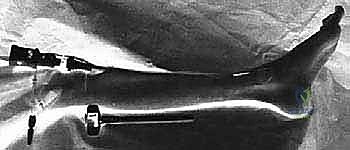 صورة طبية: بضع اللفافة لعلاج متلازمة الحيز الجهدي المزمنة: دليل شامل للمرضى مع الأستاذ الدكتور محمد هطيف