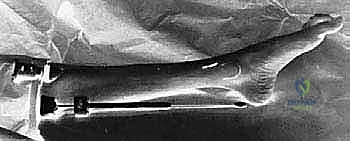 صورة توضيحية لـ بضع اللفافة لعلاج متلازمة الحيز الجهدي المزمنة: دليل شامل للمرضى مع الأستاذ الدكتور محمد هطيف