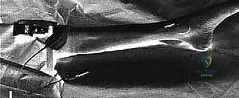 صورة توضيحية لـ بضع اللفافة لعلاج متلازمة الحيز الجهدي المزمنة: دليل شامل للمرضى مع الأستاذ الدكتور محمد هطيف