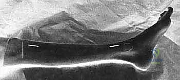 صورة طبية: بضع اللفافة لعلاج متلازمة الحيز الجهدي المزمنة: دليل شامل للمرضى مع الأستاذ الدكتور محمد هطيف