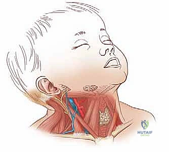 التشخيص السريري والشعاعي لحالة الصعر العضلي