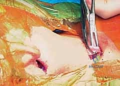 عملية تحرير العضلة القصية الترقوية الخشائية لعلاج الصعر العضلي الخلقي لدى الأطفال