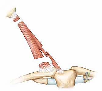 خطوات عملية تحرير العضلة القصية الترقوية الخشائية