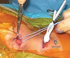 صورة توضيحية لـ عملية تحرير العضلة القصية الترقوية الخشائية لعلاج الصعر العضلي الخلقي لدى الأطفال