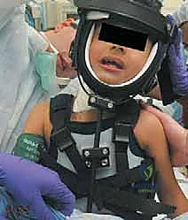 Illustration of congenital muscular torticollis - Dr. Mohammed Hutaif