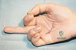 إصلاح أوتار اليد القابضة في المنطقة الثانية دليل شامل للمرضى مع الأستاذ الدكتور محمد هطيف