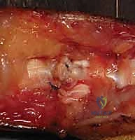 الفحص السريري لقطع الأوتار