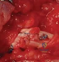 صورة طبية: إصلاح أوتار اليد القابضة في المنطقة الثانية دليل شامل للمرضى مع الأستاذ الدكتور محمد هطيف