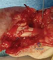 إصلاح الأعصاب الدقيقة