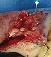 الشق الجراحي المتعرج