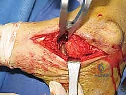 تحضير المفصل تحت الكاحل