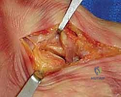 الاندماج الثلاثي للقدم عبر شق واحد: حل متقدم لتشوهات القدم المعقدة في صنعاء مع الأستاذ الدكتور محمد هطيف