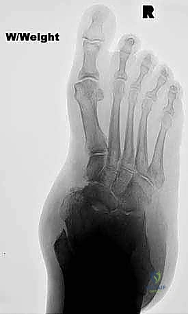 الوصول إلى المفصل عبر الشق الإنسي