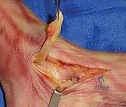 تحضير الأسطح العظمية للدمج