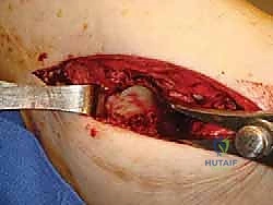 تثبيت المفاصل باستخدام البراغي الطبية