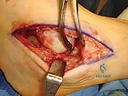 التأكد من التثبيت عبر الأشعة السينية أثناء الجراحة