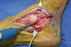 استعادة المحاذاة الطبيعية للقدم