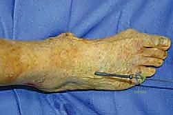 وضع الطعوم العظمية لتعزيز الاندماج