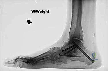 إغلاق الشق الجراحي الإنسي الواحد