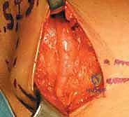 صورة توضح آلية تدلي القدم وانضغاط العصب الشظوي