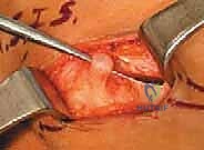 صورة توضيحية لـ تحرير الأعصاب الطرفية: علاج انضغاط العصب الفخذي الجلدي الوحشي والشظوي المشترك في صنعاء مع الأستاذ الدكتور محمد هطيف